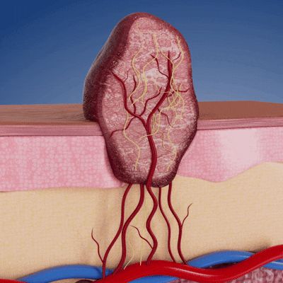 GFOUK Skin Tag Removal Patch