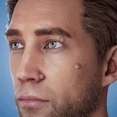 GFOUK Skin Tag Removal Patch