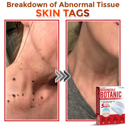GFOUK Skin Tag Removal Patch